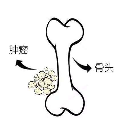 骨腫瘤的聚焦超聲消融手術(shù)治療