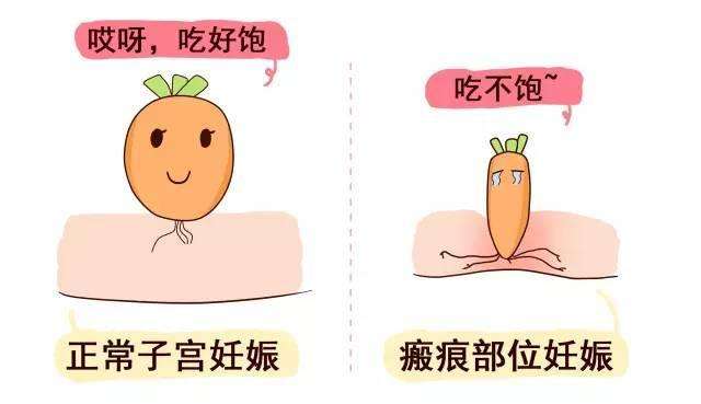 瘢痕妊娠的聚焦超聲消融手術(shù)治療