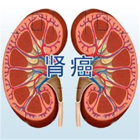 什么是腎癌？