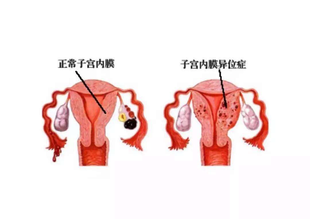 子宮內(nèi)膜異位癥的聚焦超聲消融手術(shù)治療