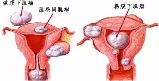 子宮肌瘤的聚焦超聲消融手術(shù)治療
