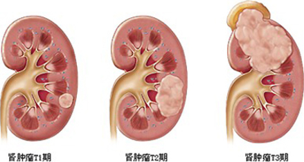 有吸煙習(xí)慣的人患胰腺癌的可能性是不吸煙的人的2至3倍