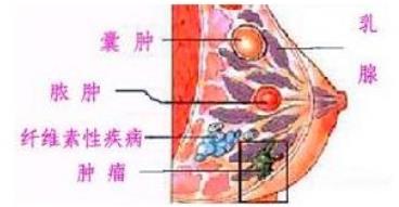 乳腺癌的癥狀有哪些？如何治療？