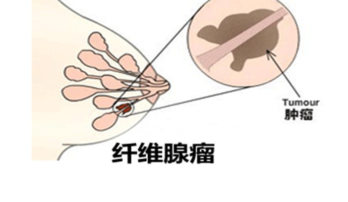 聚焦超聲消融手術(shù)治療乳腺纖維瘤
