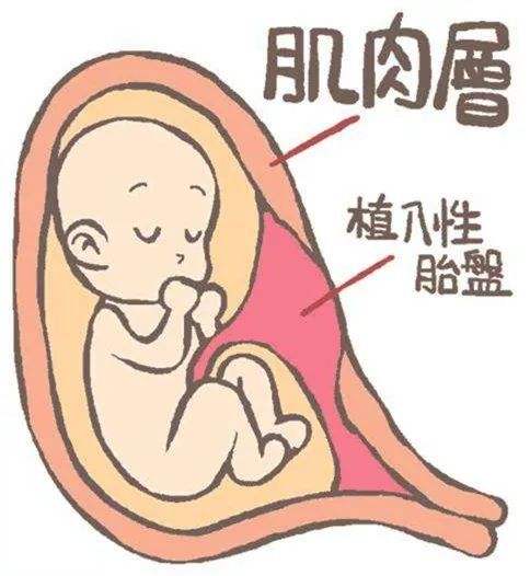 有關(guān)子宮肌瘤的病因迄今仍不十分清楚