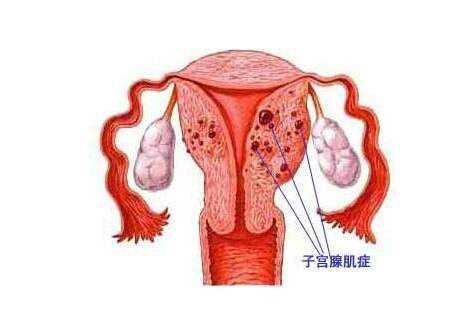 子宮肌瘤是一種激素依賴性腫瘤