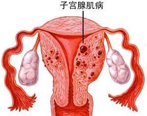 有關(guān)子宮肌瘤的病因迄今仍不十分清楚